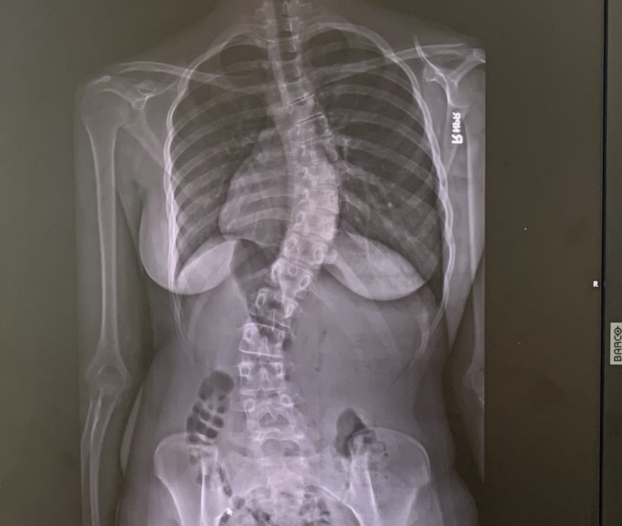 Bending the perception of scoliosis