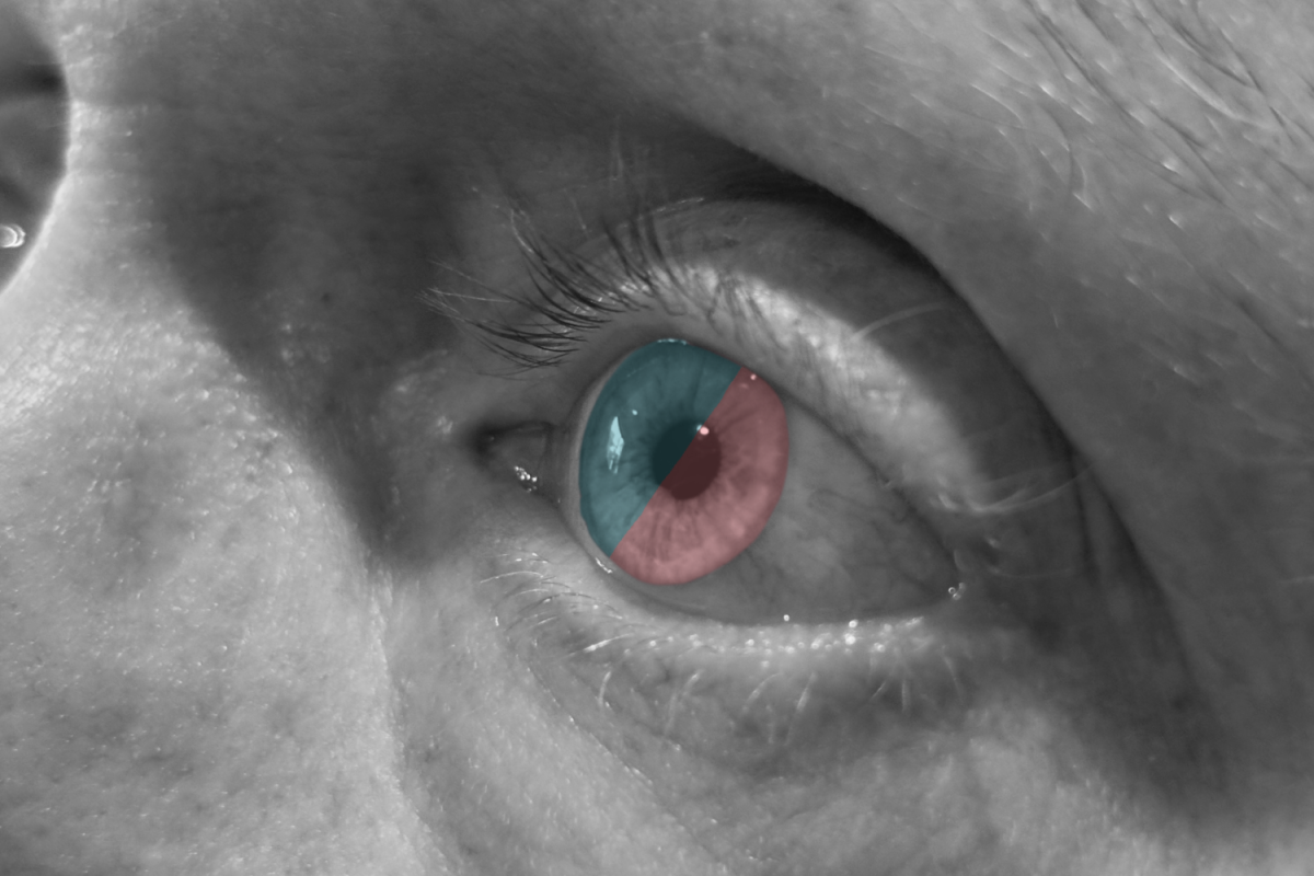 A person with tritanopia, also known as blue-yellow color deficiency, sees the world in mostly red, pink, grey, and turquoise. However, not every person with this deficiency sees the same thing. “It's not that people with the same deficiency are all the same. Some of them are almost color blind, and some of them have such a small change in color sensitivity that you'd have to do deep diagnostic tests to find it. It's a whole spectrum,” said Michael Marmor, M.D., a professor of Ophthalmology and Human Biology at Stanford University School of Medicine.