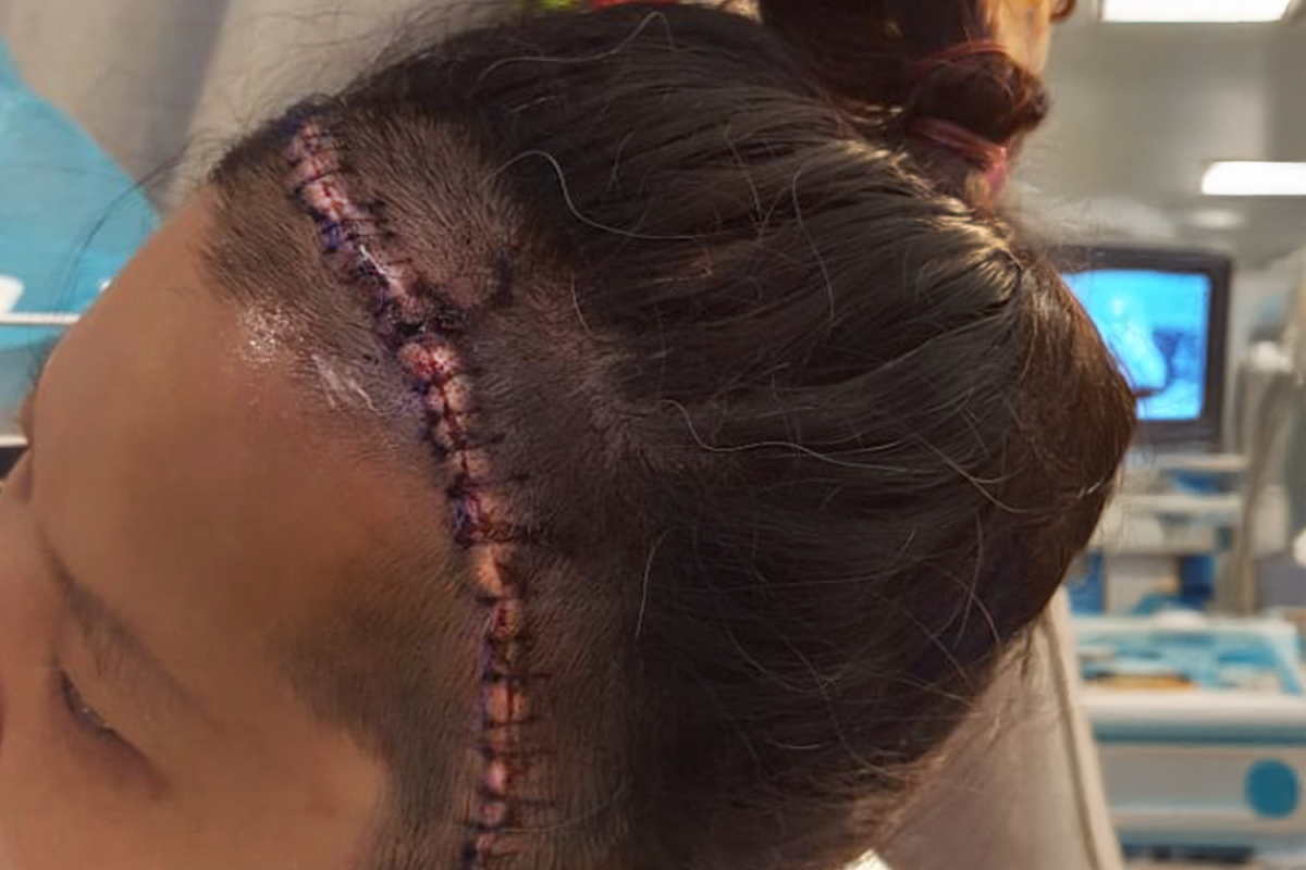 Novem Chua was rushed in for surgery after her brain aneurysm ruptured in 2017. During the surgery, the team of neurosurgeons had to cut her head open from the top, and it had to be stitched up, leaving a scar. She now has to check in yearly for annual surgeries at the hospital.