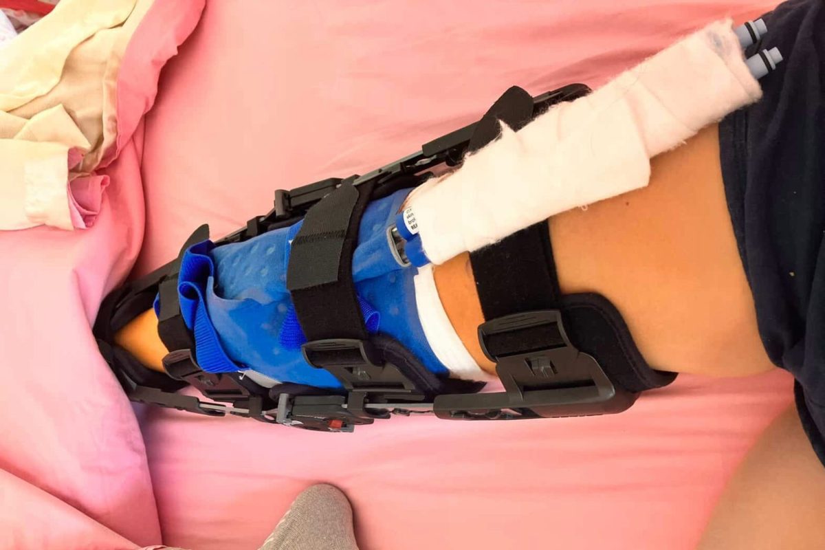 Sophomore Elizabeth Whitehead (10) lays in bed after receiving an ACL reconstruction surgery. Whitehead tore her ACL during field hockey practice on the second day of school; the recovery typically takes 9 months. Provided by Elizabeth Whitehead.